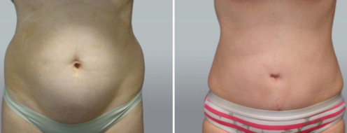 Tummy Tuck Photos 8 Abdominoplasty (Tummy Tuck) images, patient 46 before and after photos post-op 6 weeks, image 106, front view