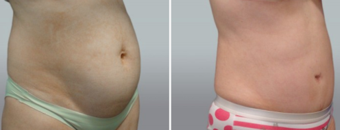 Patient 46, Abdominoplasty (Tummy Tuck) before and after image 107