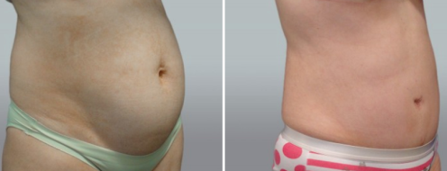 Tummy Tuck Photos 7 Patient 46, Abdominoplasty (Tummy Tuck) before and after photos post-op 6 weeks, image 107