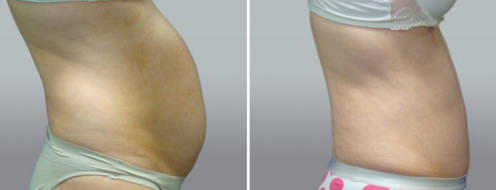 Tummy Tuck Photos 1 Abdominoplasty (Tummy Tuck) before and after photos post-op 6 weeks, patient 46, image 108, side view