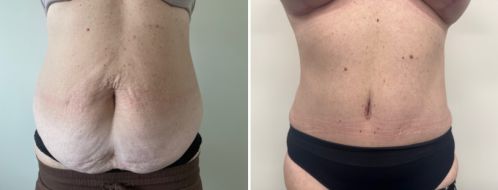 Tummy Tuck Photos 1 Abdominoplasty (tummy tuck). After photo at 6 months