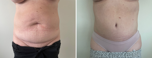 Tummy Tuck Photos 114 Abdominoplasty (Tummy Tuck), patient R, before and after photos post-op 6 weeks, image 109, front view
