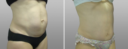 Tummy Tuck Photos 103 Abdominoplasty (Tummy Tuck), image 11, before and after photos post-op 6 weeks, angle view