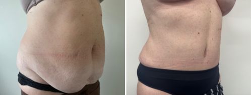 Tummy Tuck Photos 2 Abdominoplasty (tummy tuck). After photo at 6 months