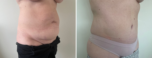 Tummy tuck gallery, patient R before & after surgery, image 110, front view