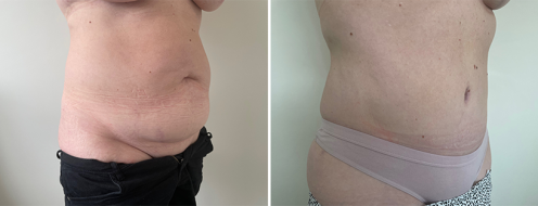 Tummy Tuck Photos 115 Abdominoplasty (Tummy Tuck) images, patient R, before and after photos post-op 6 weeks, image 110, front view