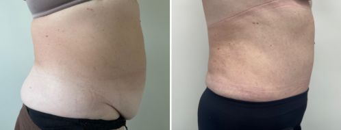 Tummy Tuck Photos 3 Abdominoplasty (tummy tuck). After photo at 6 months