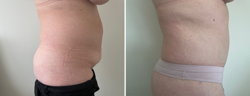 Tummy Tuck Photos 116 Abdominoplasty (Tummy Tuck) images, patient R, before and after photos post-op 6 weeks, image 111, side view