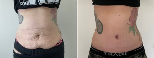 Tummy Tuck Photos 4 Abdominoplasty (tummy tuck). After photo at 6 months