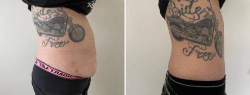 Tummy Tuck Photos 5 Abdominoplasty (tummy tuck). After photo at 6 months