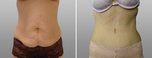 Front view of a tummy tuck patient before and after tummy tuck, image 12
