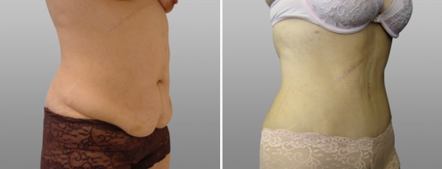 Tummy Tuck Photos 101 Abdominoplasty (Tummy Tuck) before and after photos post-op 6 weeks, patient 5, side view
