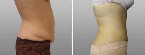 Tummy Tuck Photos 100 Abdominoplasty (Tummy Tuck) before and after photos post-op 6 weeks images with Dr Norris, patient 5