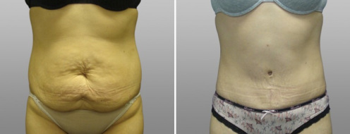 Tummy Tuck Photos 99 Abdominoplasty (Tummy Tuck) photos, patient 6, before and after photos post-op 6 weeks surgery images, front view