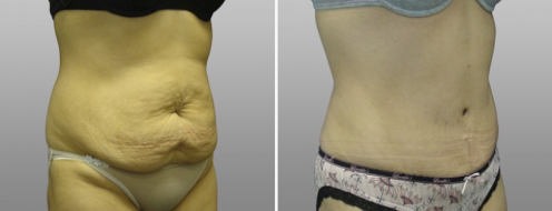 Abdominoplasty, image gallery, patient 6, angle view