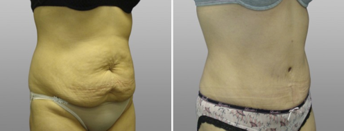 Tummy Tuck Photos 98 Abdominoplasty (Tummy Tuck), before and after photos post-op 6 weeks, patient 6, angle view
