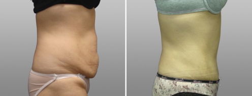 Abdominoplasty (Tummy Tuck) before and after images, patient 6, side view