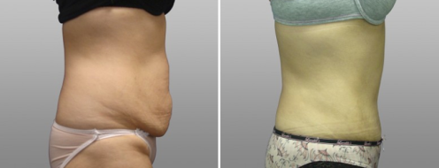 Tummy Tuck Photos 97 Abdominoplasty (Tummy Tuck) before and after photos post-op 6 weeks, patient 6, side view