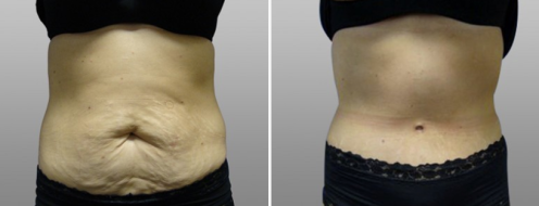 Patient 7, front, tummy tuck before and after