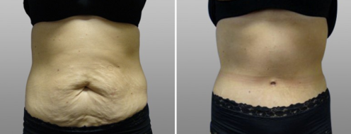 Tummy Tuck Photos 96 Patient 7, front, Abdominoplasty (Tummy Tuck) before and after photos post-op 6 weeks