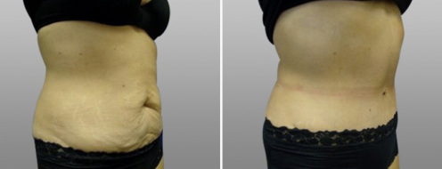 Tummy Tuck Photos 95 Abdominoplasty (Tummy Tuck), patient 7, Dr Norris, before and after photos post-op 6 weeks
