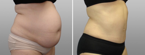 Tummy Tuck Photos 112 Abdominoplasty (Tummy Tuck) before and after photos post-op 6 weeks, surgery with Dr Norris, patient 1, side view