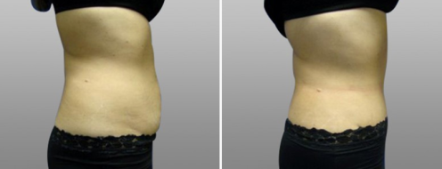 Tummy Tuck Photos 94 Abdominoplasty (Tummy Tuck), patient 20, side view, before and after photos post-op 6 weeks
