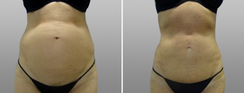 Abdominoplasty before and after, image 21, front view