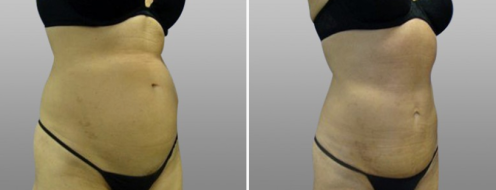 Tummy Tuck Photos 92 Abdominoplasty (Tummy Tuck) before and after photos post-op 6 weeks, image 22, angle view, patient 8