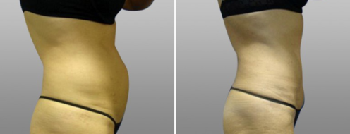 Tummy Tuck Photos 91 Side view of a Abdominoplasty (Tummy Tuck) patient, before and after photos post-op 6 weeks, image 23