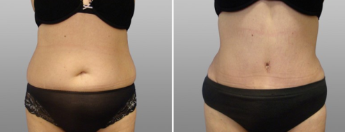 Tummy Tuck Photos 90 Dr Norris Abdominoplasty (Tummy Tuck) patient before and after photos post-op 6 weeks, image 24