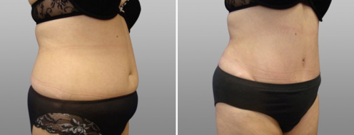 Tummy tuck image 25, angle view, Form & Face Sydney