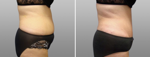 Tummy Tuck Photos 88 Abdominoplasty (Tummy Tuck) surgery with Dr Norris, Form & Face Sydney, image 26, before and after photos post-op 6 weeks