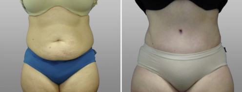 Tummy Tuck Photos 87 Patient before and after photos post-op 6 weeks, Abdominoplasty (Tummy Tuck), front view