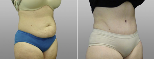 Tummy Tuck Photos 86 Patient image 28, Abdominoplasty (Tummy Tuck) photos, angle view, before and after photos post-op 6 weeks