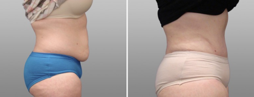 Tummy Tuck Photos 85 Abdominoplasty (Tummy Tuck) before and after photos post-op 6 weeks, patient 10, side view