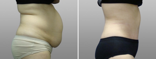 Tummy Tuck Photos 111 Abdominoplasty (Tummy Tuck), patient 01, before and after photos post-op 6 weeks, side view