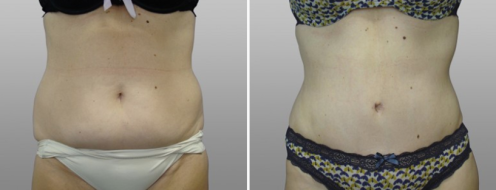 Patient 11, front view, tummy tuck before and after