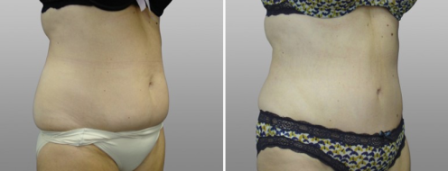 Tummy Tuck Photos 83 Abdominoplasty (Tummy Tuck), patient 11, before and after photos post-op 6 weeks