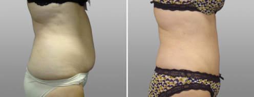 Tummy tuck before and after, side view, patient 11