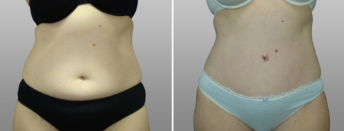 Tummy Tuck Photos 81 Abdominoplasty (Tummy Tuck) surgery at Form Face clinic, patient 13, before and after photos post-op 6 weeks, front