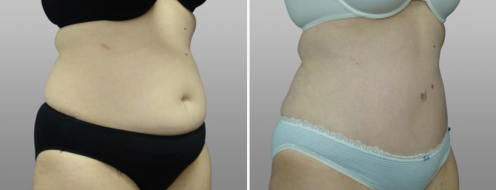 Tummy Tuck Photos 80 Image of patient 12, Abdominoplasty (Tummy Tuck) in Sydney, angle view, before and after photos post-op 6 weeks