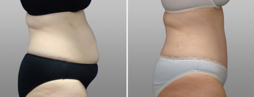 Tummy Tuck Photos 79 Abdominoplasty (Tummy Tuck) before and after photos post-op 6 weeks, patient 12, side view