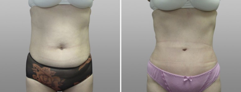 Before and after abdominoplasty, image 36, front view