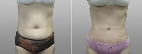 Tummy Tuck Photos 78 before and after photos post-op 6 weeks, Abdominoplasty (Tummy Tuck) images, image 36, front view