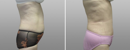 Tummy Tuck Photos 77 Abdominoplasty (Tummy Tuck) surgery photos, before and after photos post-op 6 weeks, patient 13, side view