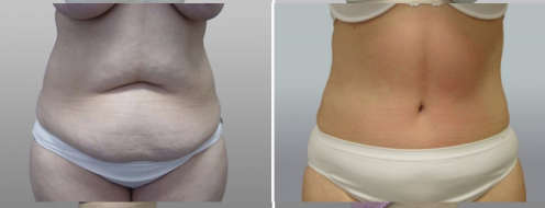 Tummy Tuck Photos 76 Patient 14, Abdominoplasty (Tummy Tuck) plastic surgery before and after photos post-op 6 weeks, image 38