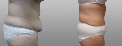 Tummy Tuck Photos 75 Abdominoplasty (Tummy Tuck), patient 14, side view, Dr Norris, before and after photos post-op 6 weeks