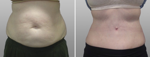 Patient 02 before and after tummy tuck, front view