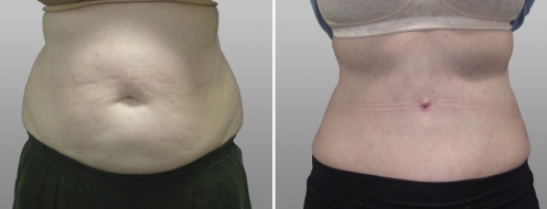 Tummy Tuck Photos 110 Patient 02, Abdominoplasty (Tummy Tuck) before and after photos post-op 6 weeks, front view